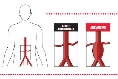 Dépistage gratuit de l'anévrisme de l'aorte abdominale